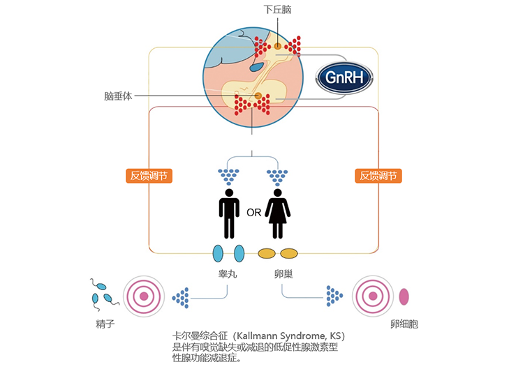  IHH/卡爾曼綜合征