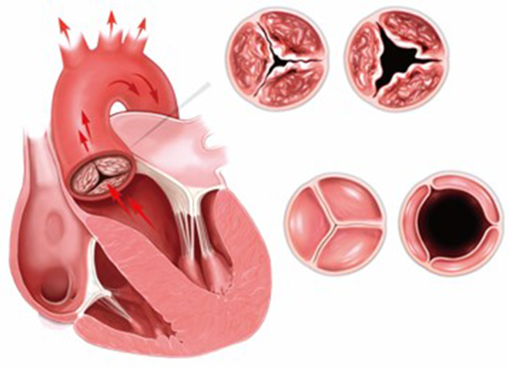 主動(dòng)脈瓣狹窄