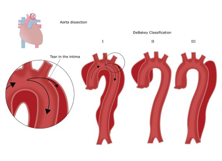 主動(dòng)脈夾層