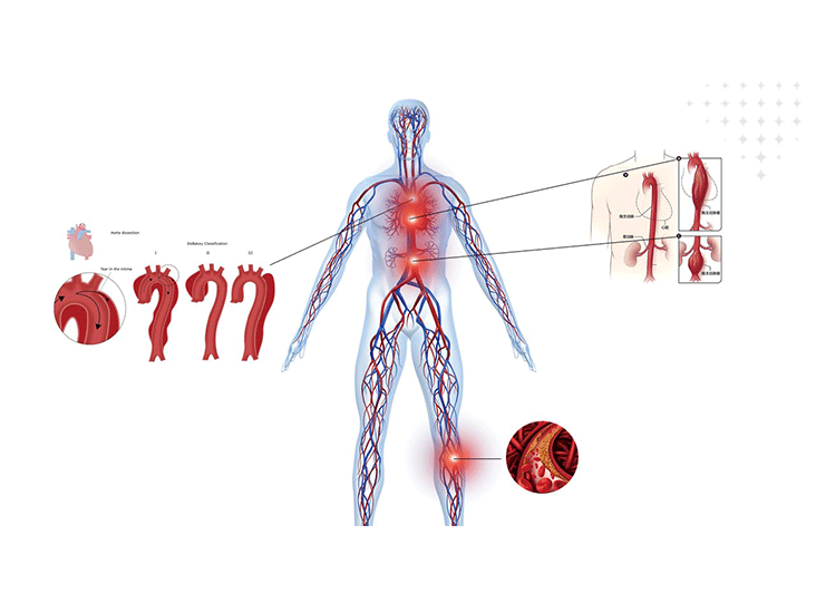 腹主動(dòng)脈瘤