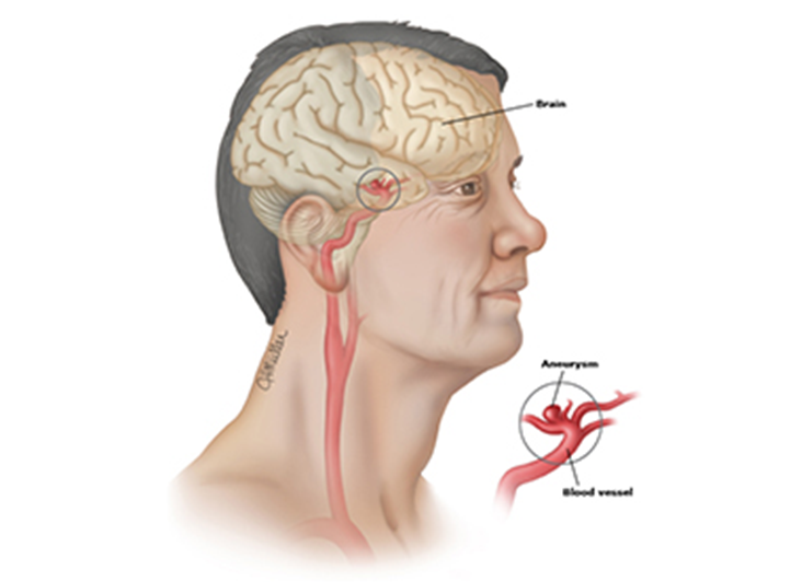 顱內(nèi)動(dòng)脈瘤