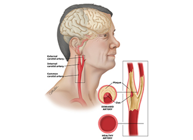  腦動(dòng)脈粥樣硬化