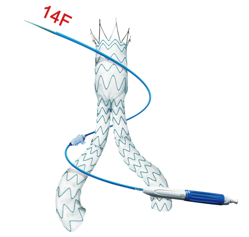 腹主動(dòng)脈覆膜支架及輸送系統(tǒng)
