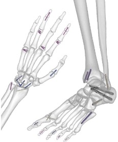 非鎖定金屬空心接骨螺釘