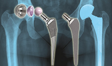 髖關(guān)節(jié)疾病與臨床術(shù)式
