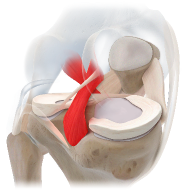 膝關(guān)節(jié)韌帶損傷與術(shù)式